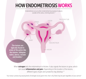 estrogen-effects-endometriosis-poster