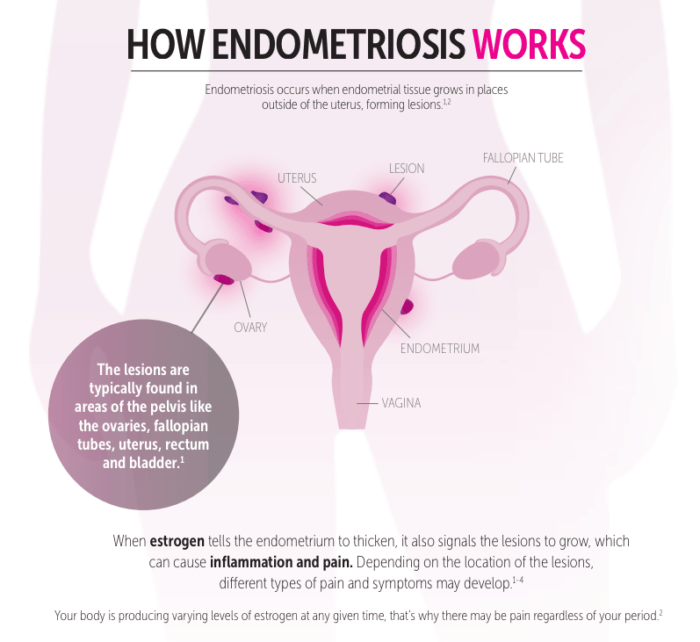 Pain from Endometriosis | Women's Health Clinic Vancouver | Dr Adatya